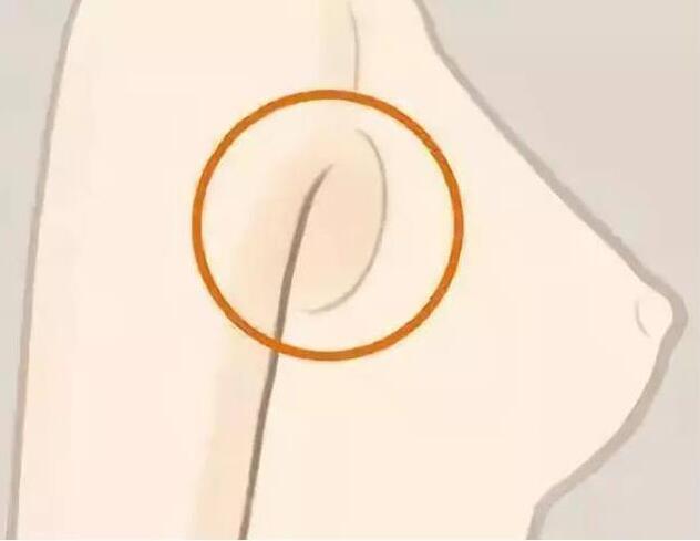 減副乳，瘦手臂一招就解決！