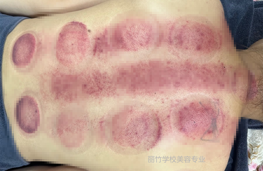 拔火罐的顏色代表什么？南寧美容美體專業(yè)實訓(xùn)