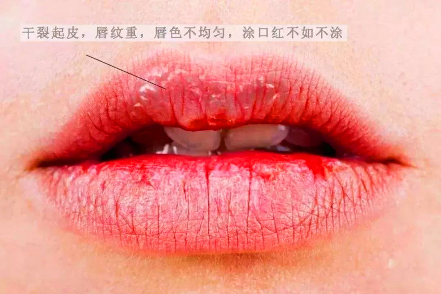 廣西皮膚管理培訓機構(gòu)：解決嘴唇干裂的急救方法