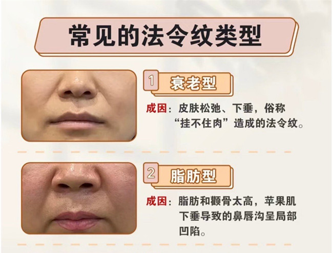 不同類型的法令紋路的產(chǎn)生，南寧專業(yè)美容護(hù)膚學(xué)校